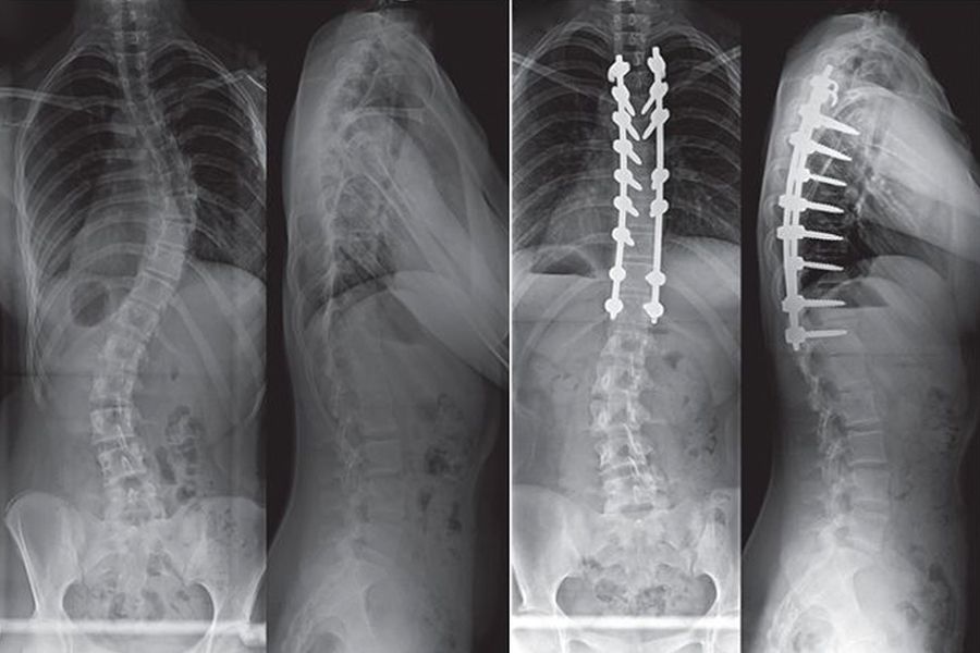 Omurga X-Ray Röntgen Karşılaştırması - Önce ve Sonra